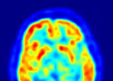 Alzheimer : Le Canada sera l’hôte d’une conférence internationale du 26 au 29 mars 2011 à Toronto
